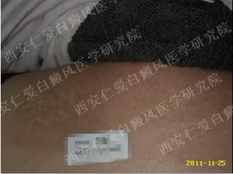 西安白癜风医院