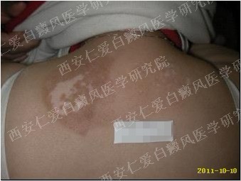 西安白癜风医院