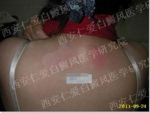 西安白癜风医院