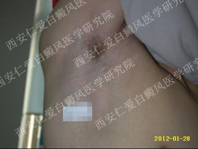 西安白癜风医院