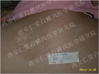 西安白癜风医院