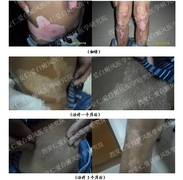 西安白癜风医院