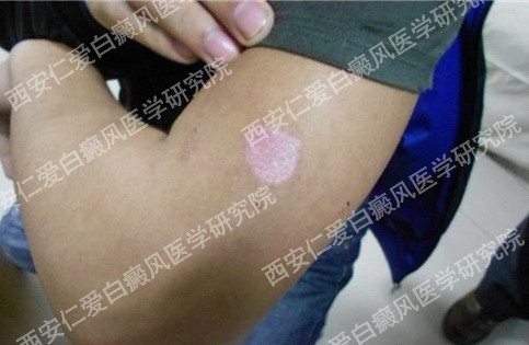 西安白癜风医院