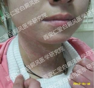 西安白癜风医院