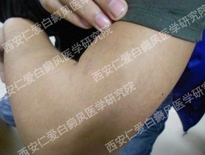 西安白癜风医院