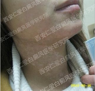 西安白癜风医院