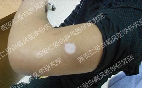 西安白癜风医院