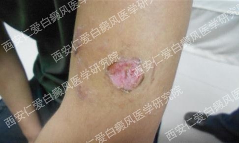 西安白癜风医院