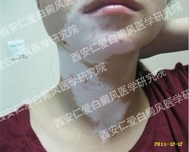 西安白癜风医院