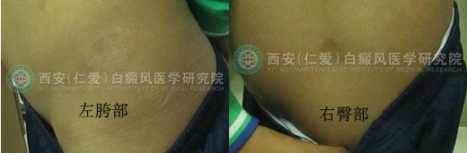 男孩一年的白癜风在我院三个月治好.jpg