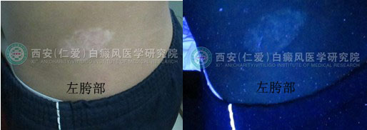 男孩一年的白癜风在我院三个月治好.jpg