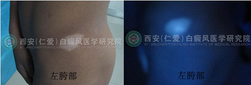 男孩一年的白癜风在我院三个月治好.jpg