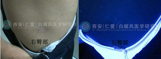 男孩一年的白癜风在我院三个月治好.jpg