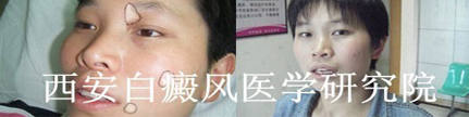 白癜风